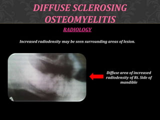 DIFFUSE SCLEROSING
OSTEOMYELITIS
RADIOLOGY
Increased radiodensity may be seen surrounding areas of lesion.

Diffuse area of increased
radiodensity of Rt. Side of
mandible

 