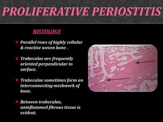 PROLIFERATIVE PERIOSTITIS
HISTOLOGY
Parallel rows of highly cellular
& reactive woven bone .
Trabeculae are frequently
oriented perpendicular to
surface.
Trabeculae sometimes form an
interconnecting meshwork of
bone.
Between trabeculae,
uninflammed fibrous tissue is
evident.

 