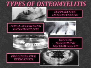 TYPES OF OSTEOMYELITIS
SUPPURATIVE
OSTEOMYELITIS
FOCAL SCLEROSING
OSTEOMYELITIS
DIFFUSE
SCLEROSING
OSTEOMYELITIS
PROLIFERATIVE
PERIOSTITIS

 