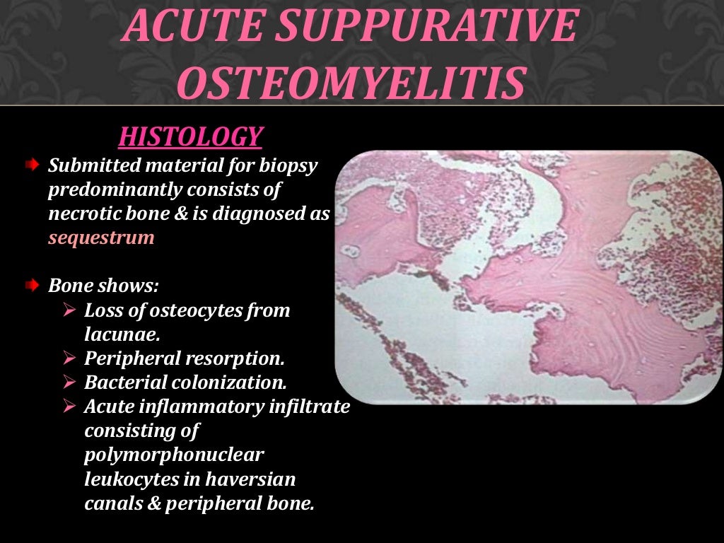 Osteomyelitis of jaw