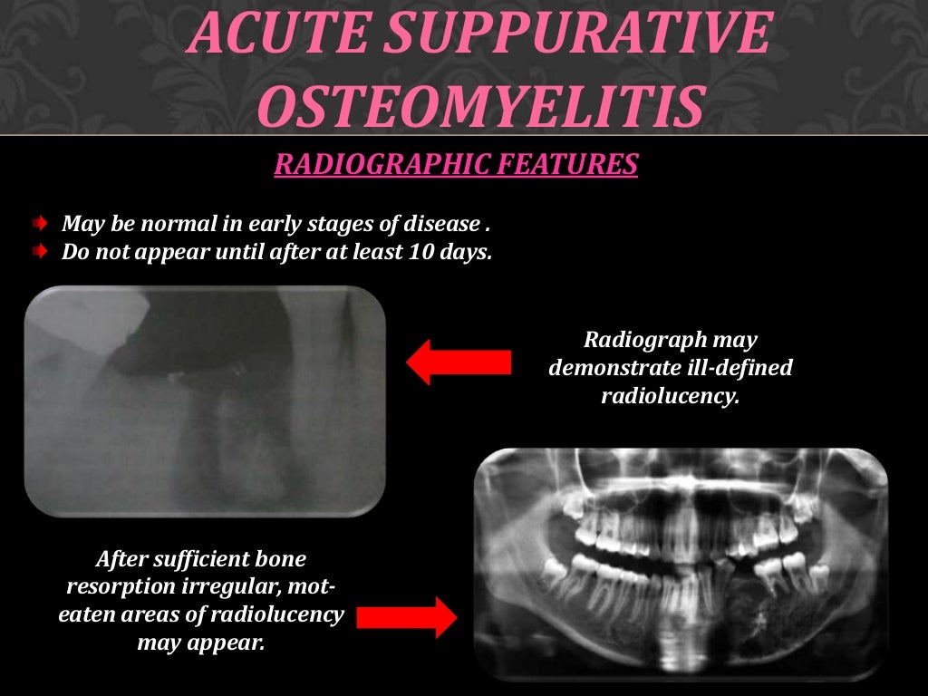 Osteomyelitis of jaw