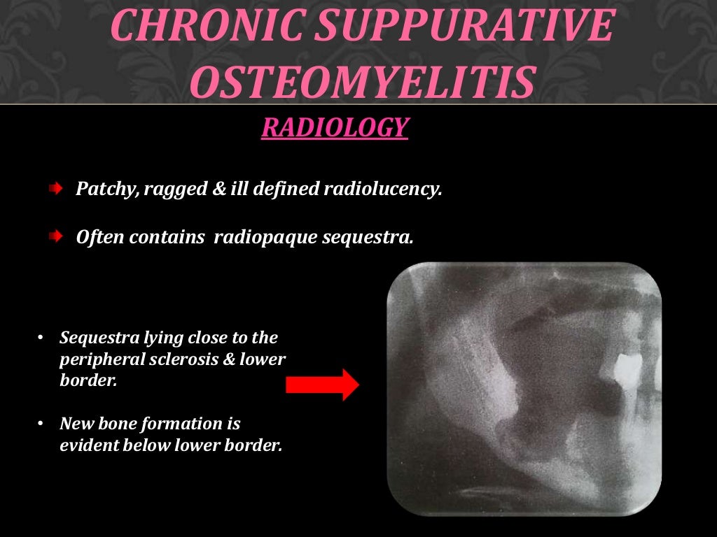 Osteomyelitis of jaw