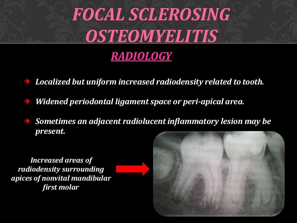 Osteomyelitis of jaw