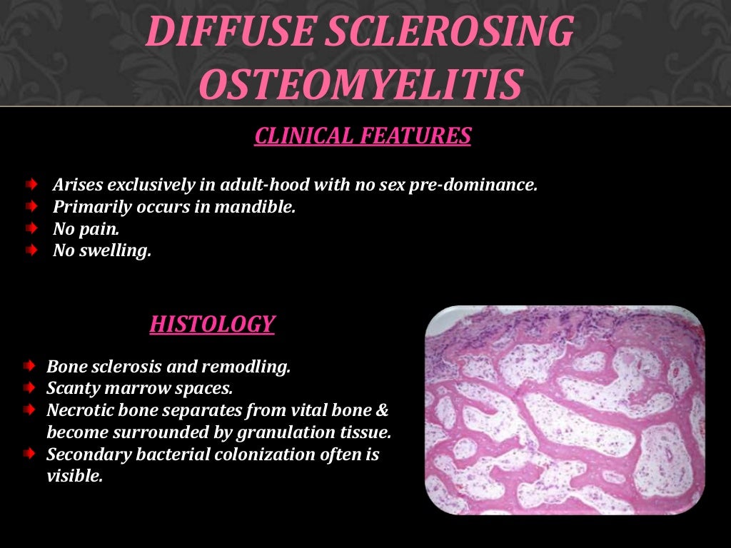 Osteomyelitis of jaw