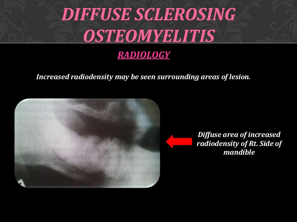 Osteomyelitis of jaw