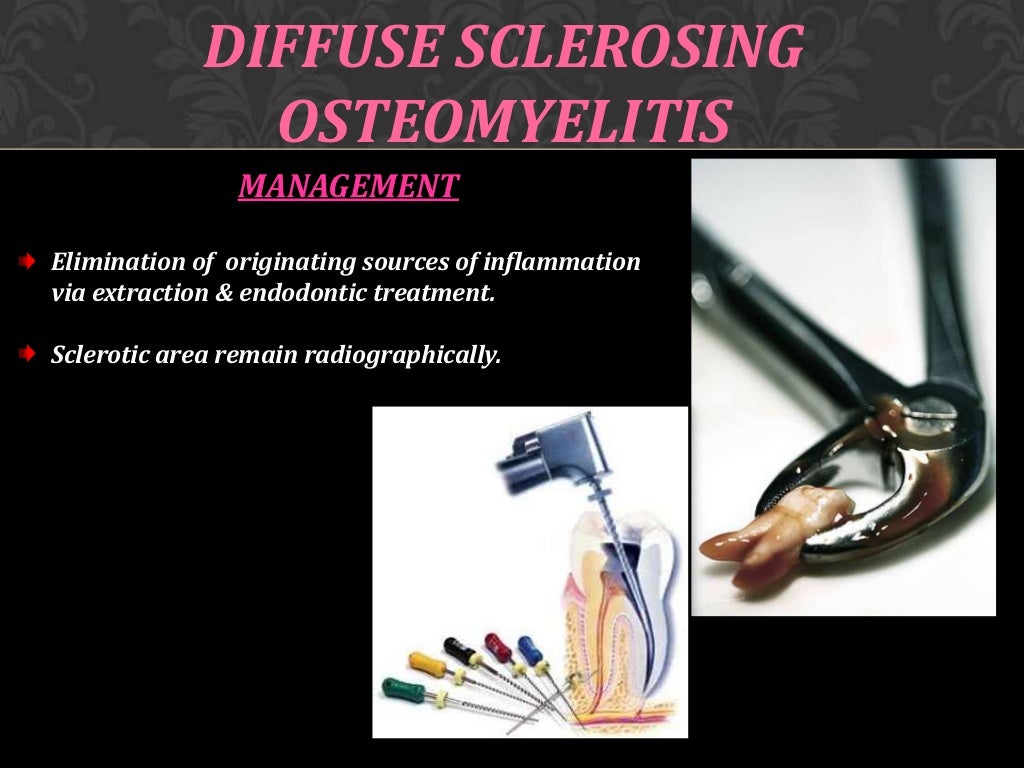 Osteomyelitis of jaw