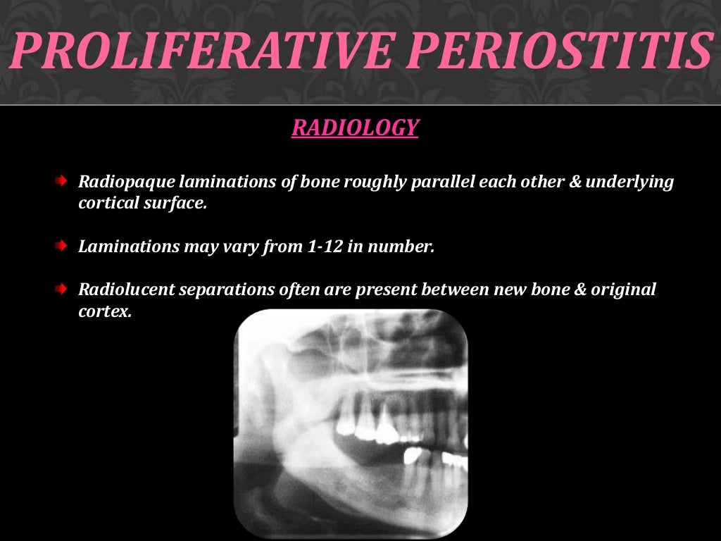 Osteomyelitis of jaw