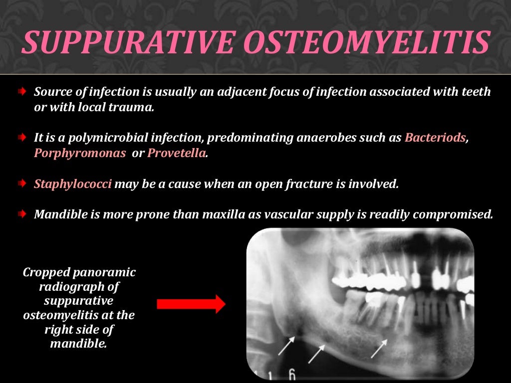 Osteomyelitis of jaw