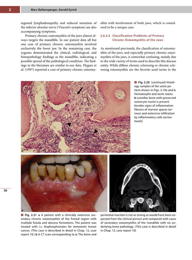 Osteomyelitis of the jaws