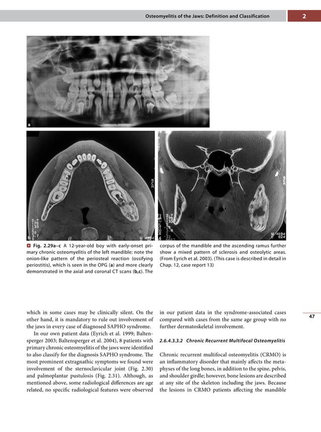 Osteomyelitis of the jaws