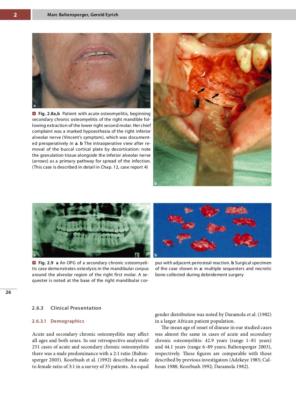 Osteomyelitis of the jaws