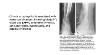 • Chronic osteomyelitis is associated with
many complications, including Marjolin’s
ulcers and SAPHO syndrome (synovitis,
acne, pustulosis, hyperostosis, and
osteitis syndrome)
 