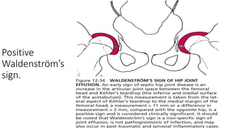 Positive
Waldenström’s
sign.
 