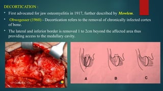 OSTEOMYLITIS IN DENTISTRY AND ITS MANAGEMENT PROTOCOL | PPTX