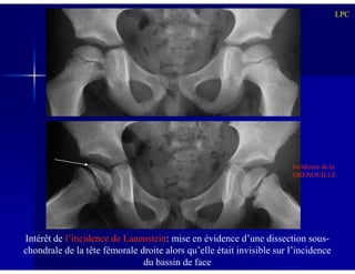 LPC
Intérêt de l’incidence de Lauenstein: mise en évidence d’une dissection sous-
chondrale de la tête fémorale droite alors qu’elle était invisible sur l’incidence
du bassin de face
Incidence de la
GRENOUILLE
 