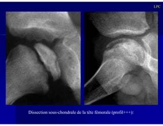 LPC
Dissection sous-chondrale de la tête fémorale (profil+++):
 