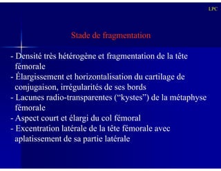 Stade de fragmentation
- Densité très hétérogène et fragmentation de la tête
fémorale
- Élargissement et horizontalisation du cartilage de
conjugaison, irrégularités de ses bords
LPC
conjugaison, irrégularités de ses bords
- Lacunes radio-transparentes (“kystes”) de la métaphyse
fémorale
- Aspect court et élargi du col fémoral
- Excentration latérale de la tête fémorale avec
aplatissement de sa partie latérale
 