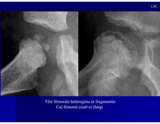LPC
Tête fémorale hétérogène et fragmentée
Col fémoral court et élargi
 