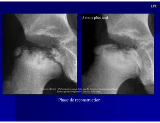 LPC
5 mois plus tard
Phase de reconstruction
D’après A Cotten – Pathologies osseuses de la hanche. Imagerie musculosquelettique.
Pathologies locorégionales. Masson, Paris 2008.
 