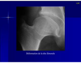 LPC
Déformation de la tête fémorale
 