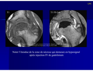 LPC
T1 T1 FS Gd
Noter l’étendue de la zone de nécrose qui demeure en hyposignal
après injection IV de gadolinium
D’après A Cotten – Pathologies osseuses de la hanche. Imagerie musculosquelettique.
Pathologies locorégionales. Masson, Paris 2008.
 