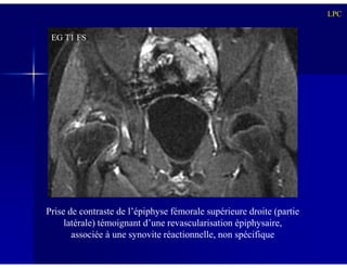LPC
EG T1 FS
Prise de contraste de l’épiphyse fémorale supérieure droite (partie
latérale) témoignant d’une revascularisation épiphysaire,
associée à une synovite réactionnelle, non spécifique
 