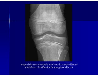 Image claire sous-chondrale au niveau du condyle fémoral
médial avec densification du spongieux adjacent
 
