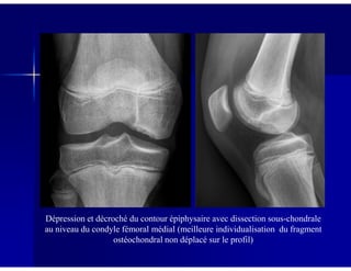 Dépression et décroché du contour épiphysaire avec dissection sous-chondrale
au niveau du condyle fémoral médial (meilleure individualisation du fragment
ostéochondral non déplacé sur le profil)
 