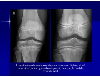Dissection sous-chondrale avec séquestre osseux non déplacé, séparé
de sa niche par une ligne radiotransparente au niveau du condyle
fémoral médial
 