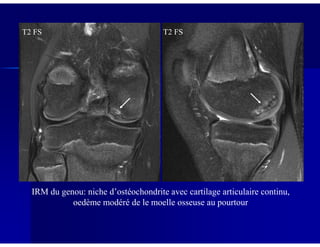 T2 FS T2 FS
IRM du genou: niche d’ostéochondrite avec cartilage articulaire continu,
oedème modéré de le moelle osseuse au pourtour
 