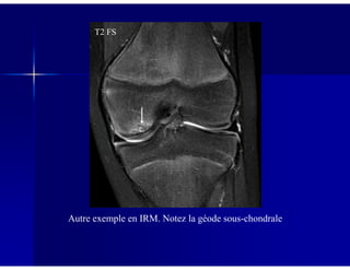 T2 FS
Autre exemple en IRM. Notez la géode sous-chondrale
 