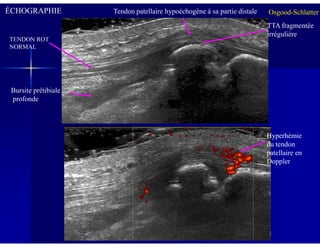 ÉCHOGRAPHIE
TENDON ROT
NORMAL
Tendon patellaire hypoéchogène à sa partie distale
Bursite prétibiale
profonde
TTA fragmentée
irrégulière
Osgood-Schlatter
Hyperhémie
du tendon
patellaire en
Doppler
 