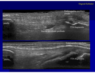 patella
Bursite pré-tibiale profonde
TTA fragmentée
Enthésopathie patellaire
distale
Osgood-Schlatter
3838
TTA fragmentée
Enthésopathie patellaire
distale
patella
 