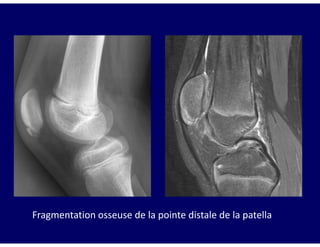 Fragmentation osseuse de la pointe distale de la patella
 