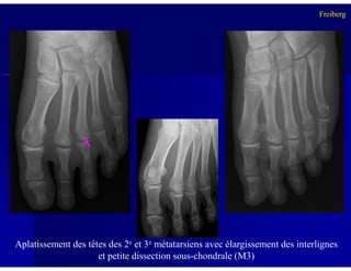Freiberg
Aplatissement des têtes des 2e et 3e métatarsiens avec élargissement des interlignes
et petite dissection sous-chondrale (M3)
 