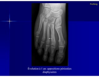 Freiberg
Évolution à 1 an: appositions périostées
diaphysaires
 