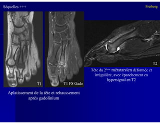 T2
Séquelles +++ Freiberg
Tête du 2ème métatarsien déformée et
irrégulière, avec épanchement en
hypersignal en T2
T2
Aplatissement de la tête et rehaussement
après gadolinium
T1 FS GadoT1
 