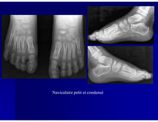 Naviculaire petit et condensé
 