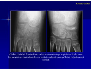 Köhler-Mouchet
Clichés réalisés à 7 mois d’intervalle chez un enfant qui se plaint de douleurs de
l’avant-pied: os naviculaire devenu petit et condensé alors qu’il était préalablement
normal.
 