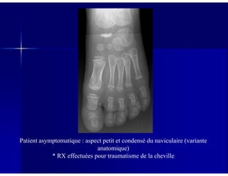 Patient asymptomatique : aspect petit et condensé du naviculaire (variante
anatomique)
* RX effectuées pour traumatisme de la cheville
 