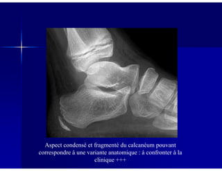 Aspect condensé et fragmenté du calcanéum pouvant
correspondre à une variante anatomique : à confronter à la
clinique +++
 