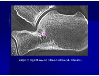 Talalgie en rapport avec un ostéome ostéoïde du calcanéus
 