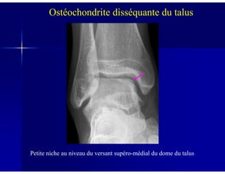 Ostéochondrite disséquante du talus
Petite niche au niveau du versant supéro-médial du dome du talus
 