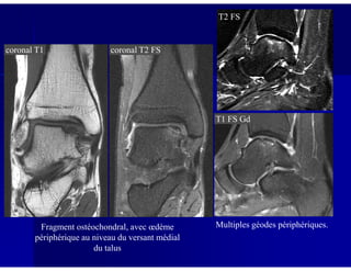 coronal T1 coronal T2 FS
T2 FS
T1 FS Gd
Fragment ostéochondral, avec œdème
périphérique au niveau du versant médial
du talus
Multiples géodes périphériques.
 