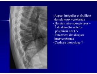 -- Aspect irrégulier et feuilletéAspect irrégulier et feuilleté
des plateaux vertébrauxdes plateaux vertébraux
-- Hernies intraHernies intra--spongieusesspongieuses ––
↑↑ du diamètre antérodu diamètre antéro--
postérieur des CVpostérieur des CV
-- Pincement des disquesPincement des disques
intervertébrauxintervertébrauxintervertébrauxintervertébraux
- Cyphose thoracique ↑
 