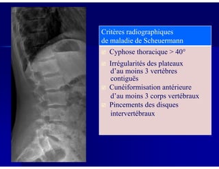 Critères radiographiques
de maladie de Scheuermann
Cyphose thoracique > 40°
Irrégularités des plateaux
d’au moins 3 vertèbres
contiguës
Cunéiformisation antérieureCunéiformisation antérieure
d’au moins 3 corps vertébraux
Pincements des disques
intervertébraux
 