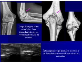 Corps étrangers intra-
articulaires, bien
individualisés sur lesindividualisés sur les
reconstructions 3D du
scanner
Échographie: corps étrangers associés à
un épanchement articulaire du récessus
coronoïde
 