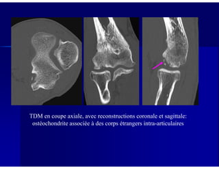 TDM en coupe axiale, avec reconstructions coronale et sagittale:
ostéochondrite associée à des corps étrangers intra-articulaires
 