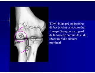 TDM: bilan pré-opératoire:
défect (niche) ostéochondral
+ corps étrangers en regard
de la fossette coronoïde et dude la fossette coronoïde et du
récessus radio-ulnaire
proximal
 