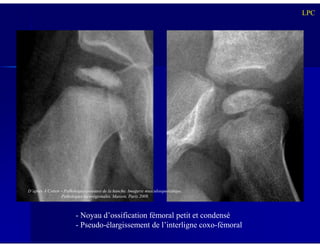 LPC
- Noyau d’ossification fémoral petit et condensé
- Pseudo-élargissement de l’interligne coxo-fémoral
D’après A Cotten – Pathologies osseuses de la hanche. Imagerie musculosquelettique.
Pathologies locorégionales. Masson, Paris 2008.
 